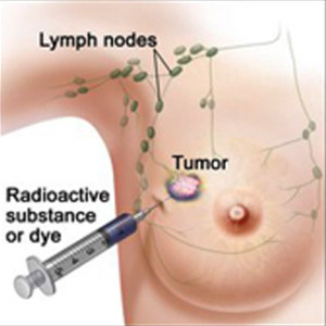 Sentinel node biopsy